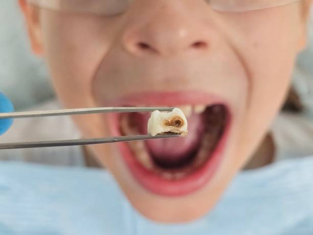 Best Root Canal Emergency Dentist  in Comer, GA